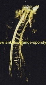ankyloserande-Spondylit.se
